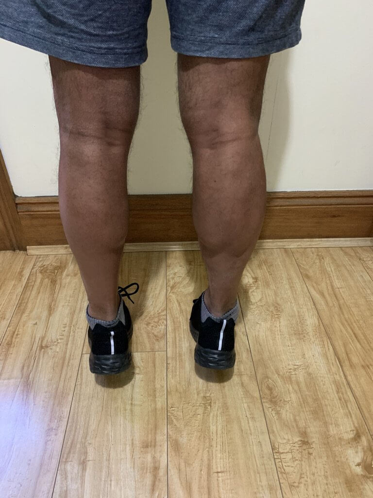 Knee Rehab post fracture
