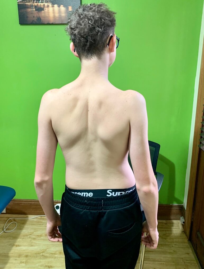 NDIS Physiotherapy: Scoliosis Management