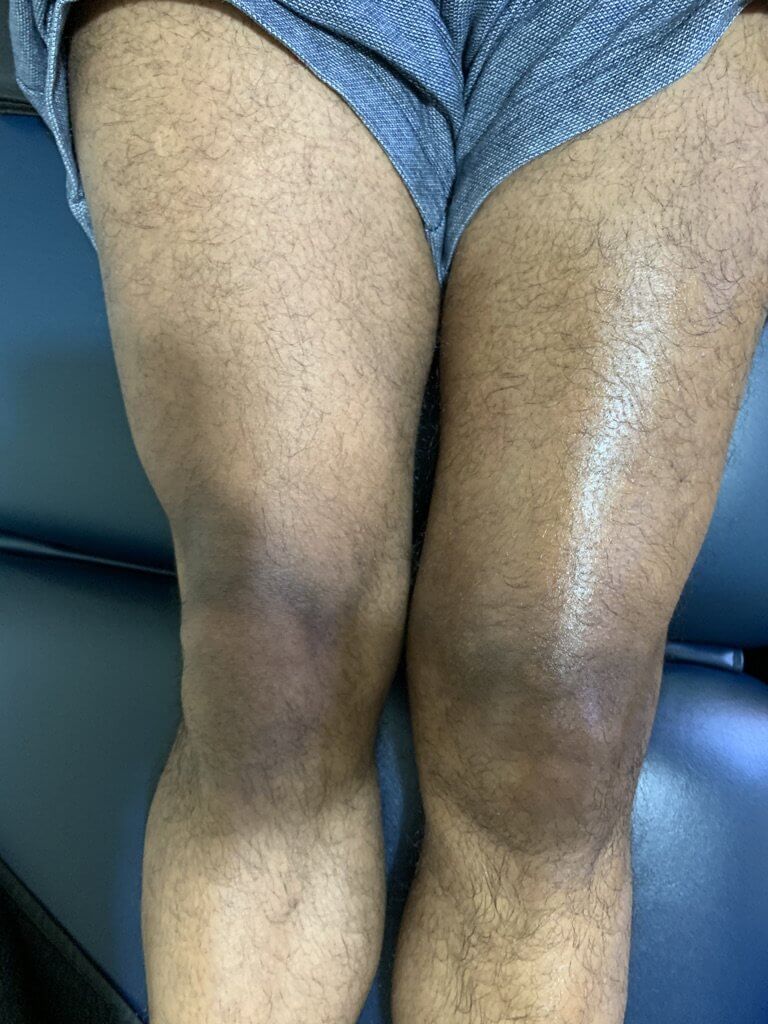 Knee weakness and swelling 6-8 weeks post fracture