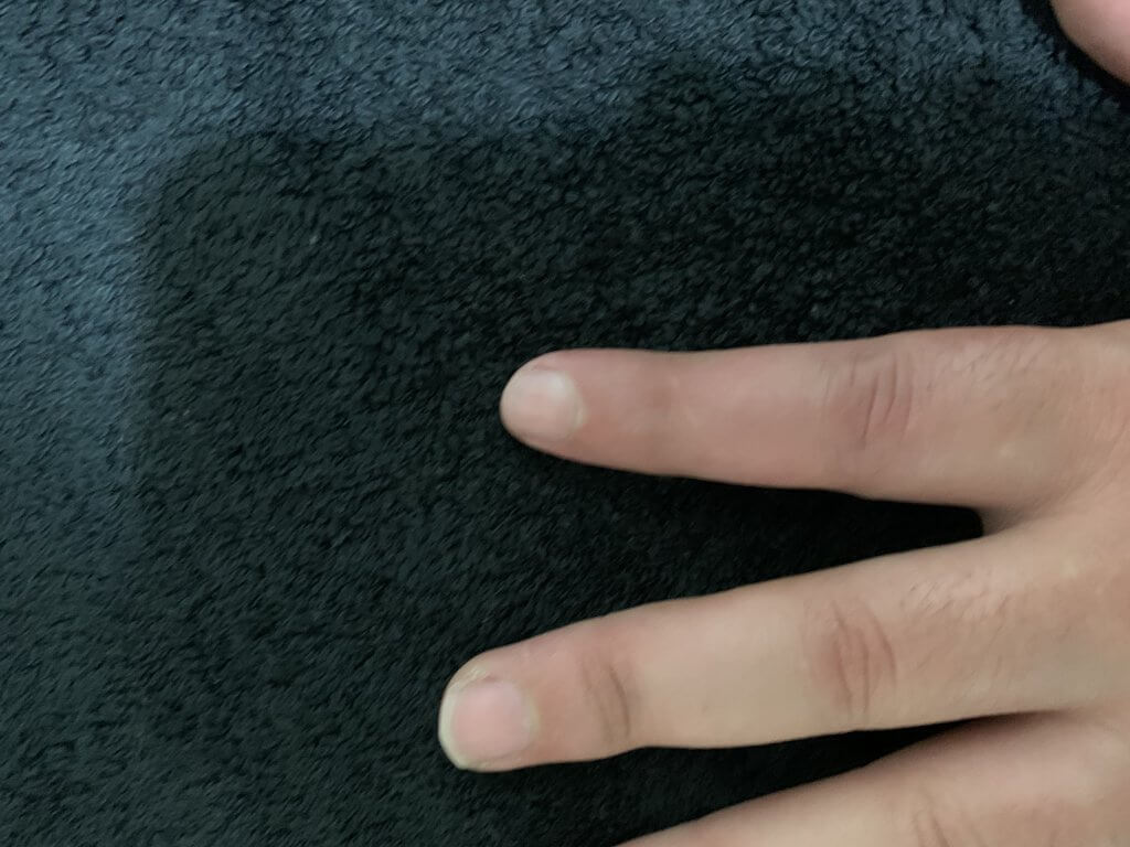 Index Finger Fracture
