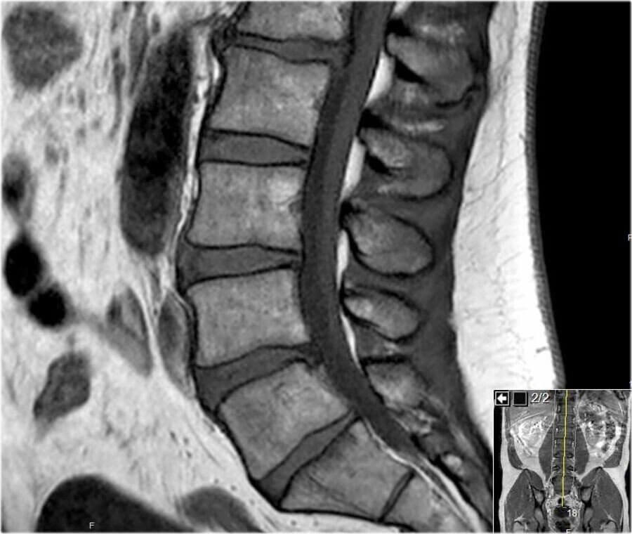 Back Disc Bulge Treatment