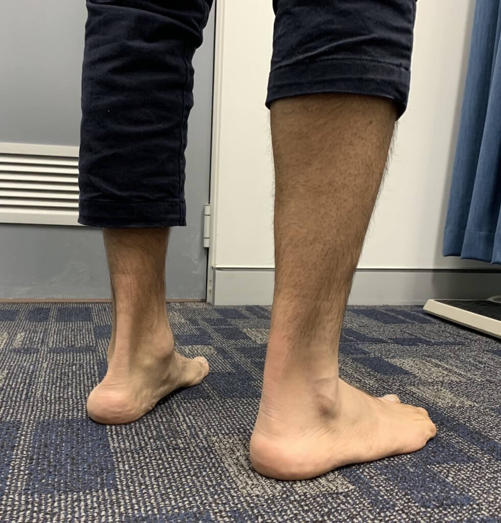 Flat Feet Treatment Physio Parramatta