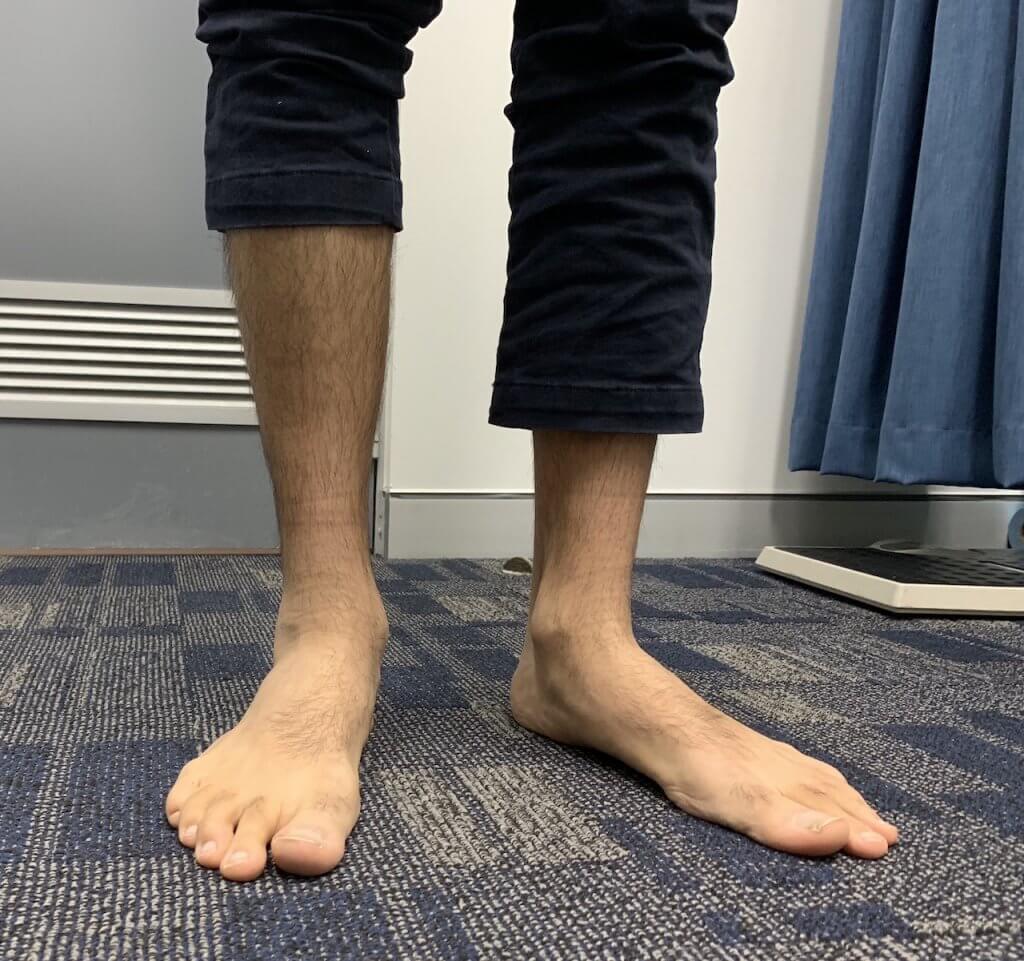 Flat Feet Treatment Physio Parramatta